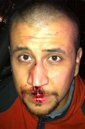 George Zimmerman bleeding