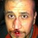 George Zimmerman bleeding